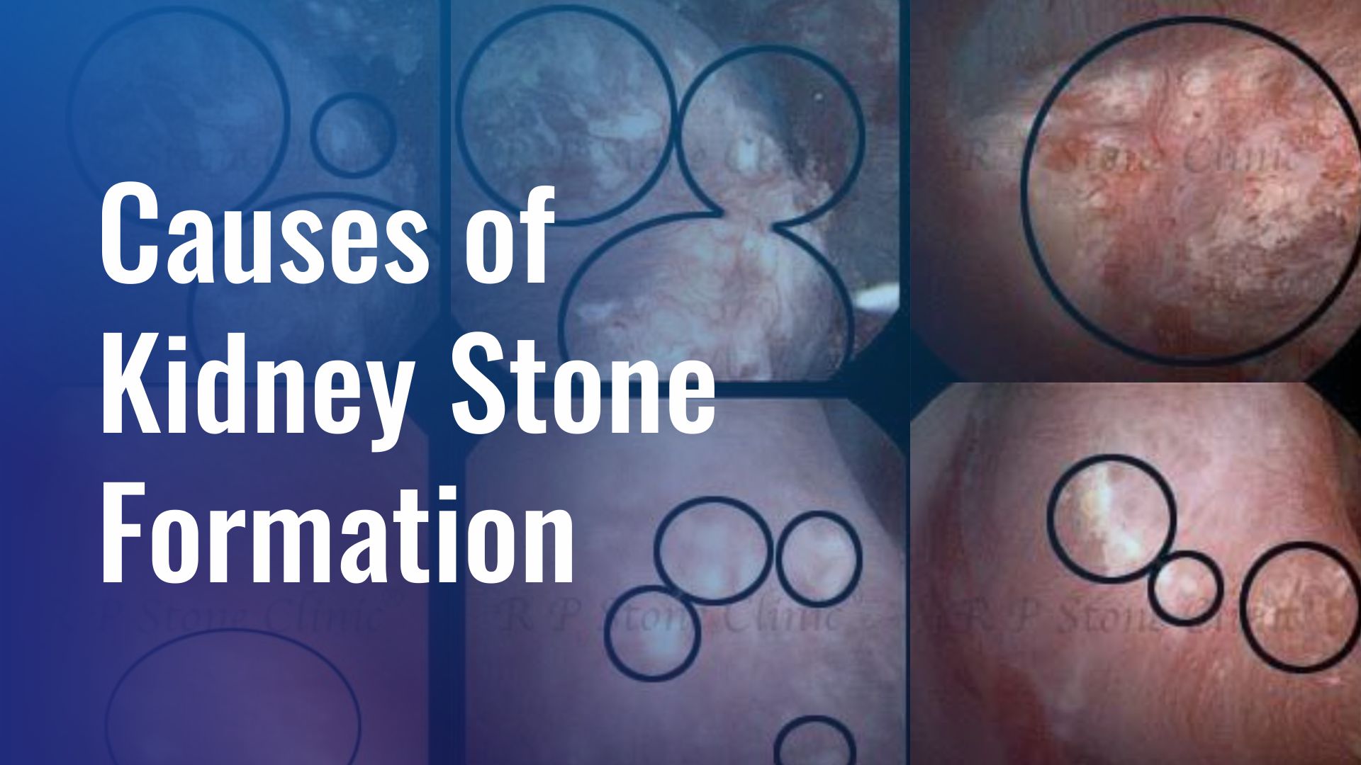 Causes of Kidney Stone Formation