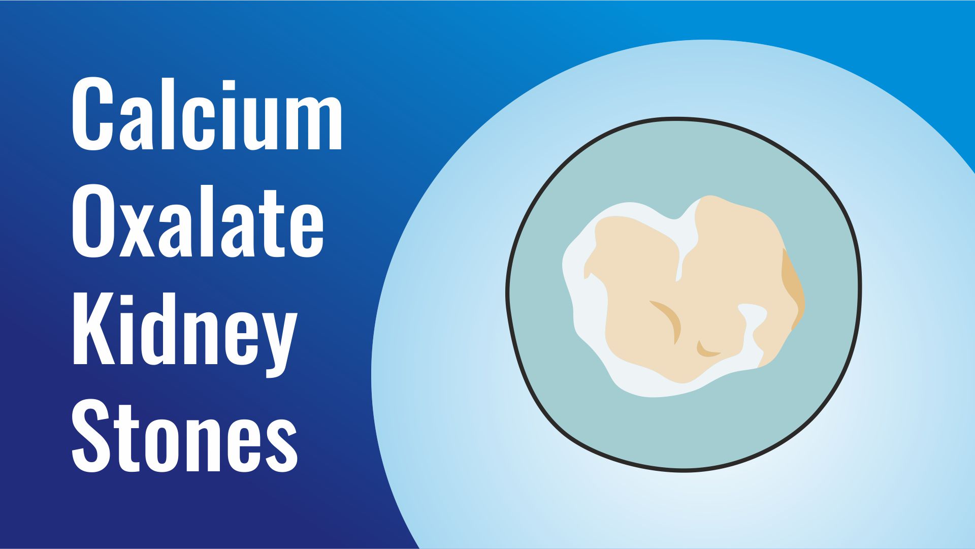 Calcium Oxalate Kidney Stones