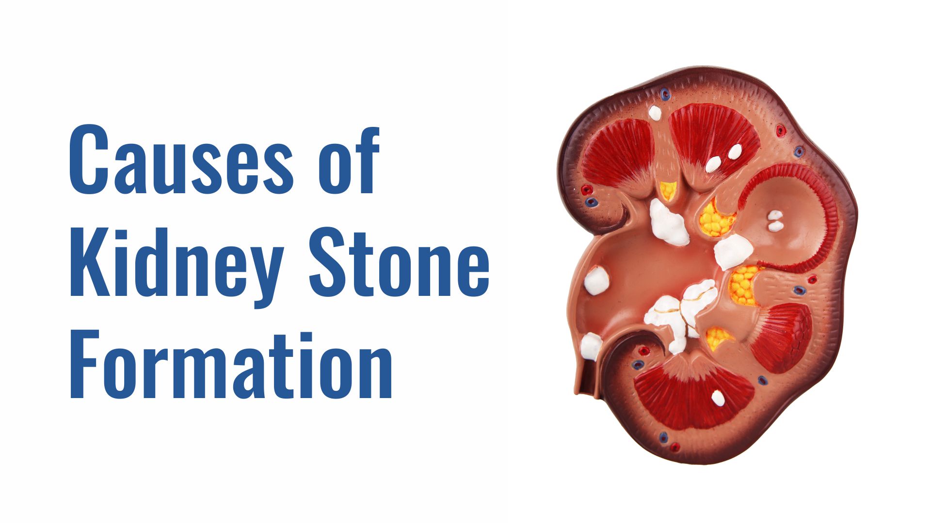 Causes of Kidney Stone Formation