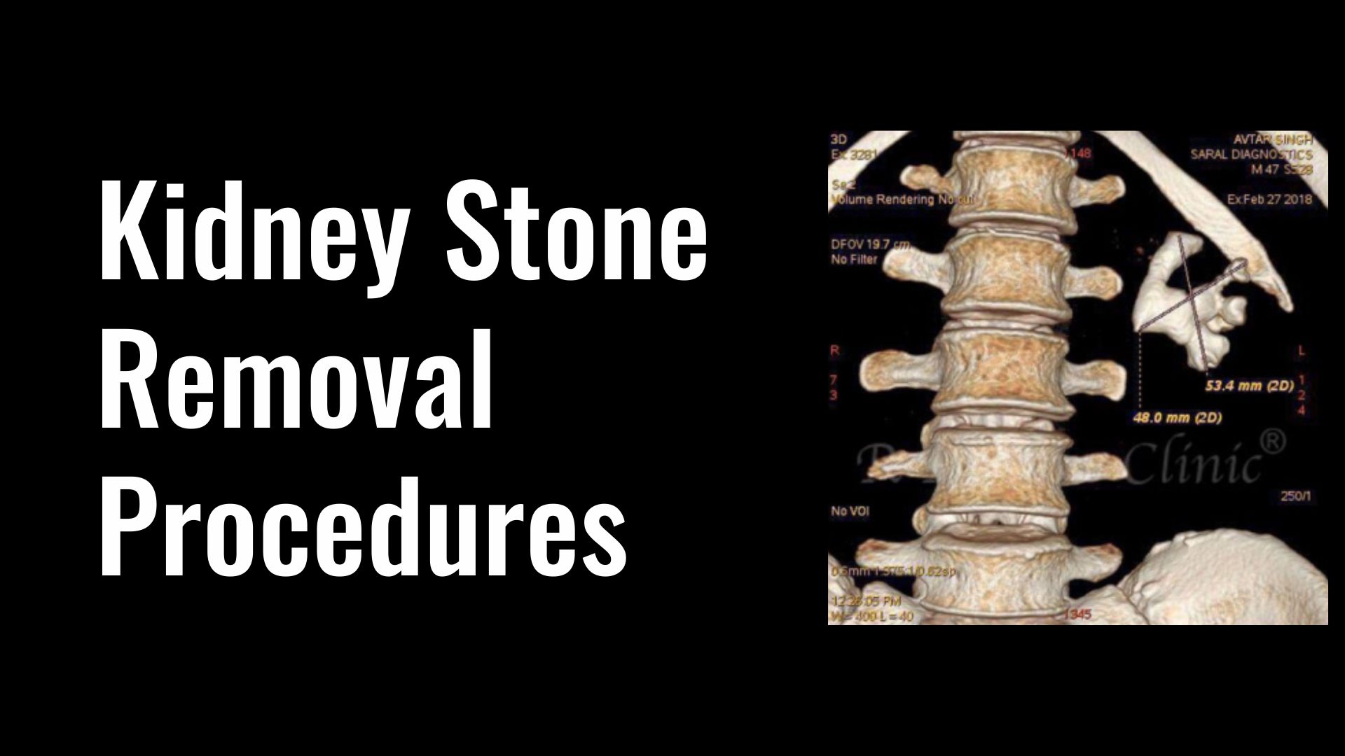 Kidney Stone Removal Procedures