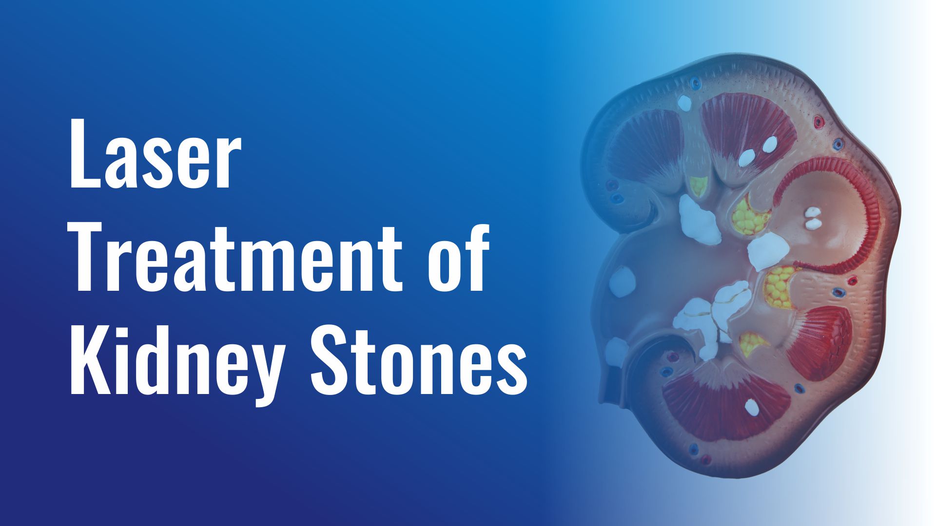 Laser Treatment of Kidney Stones