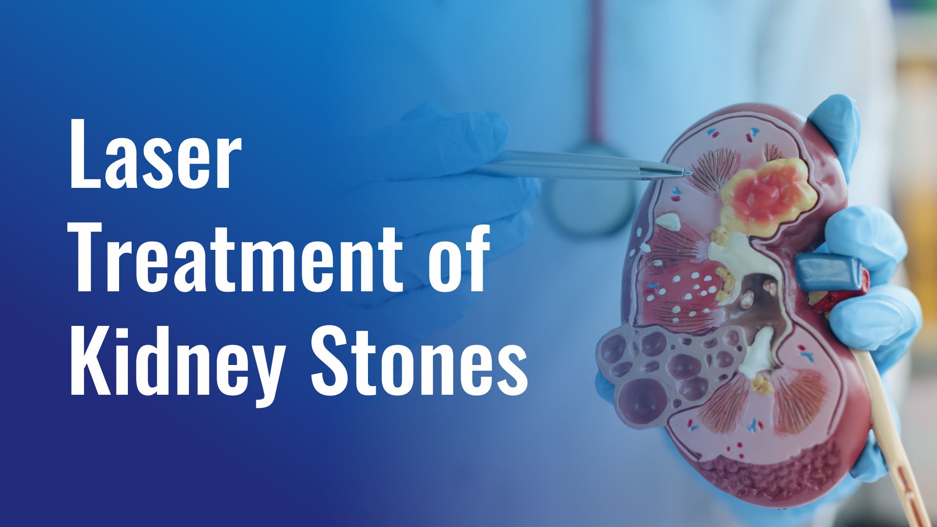 Laser Treatment of Kidney Stones