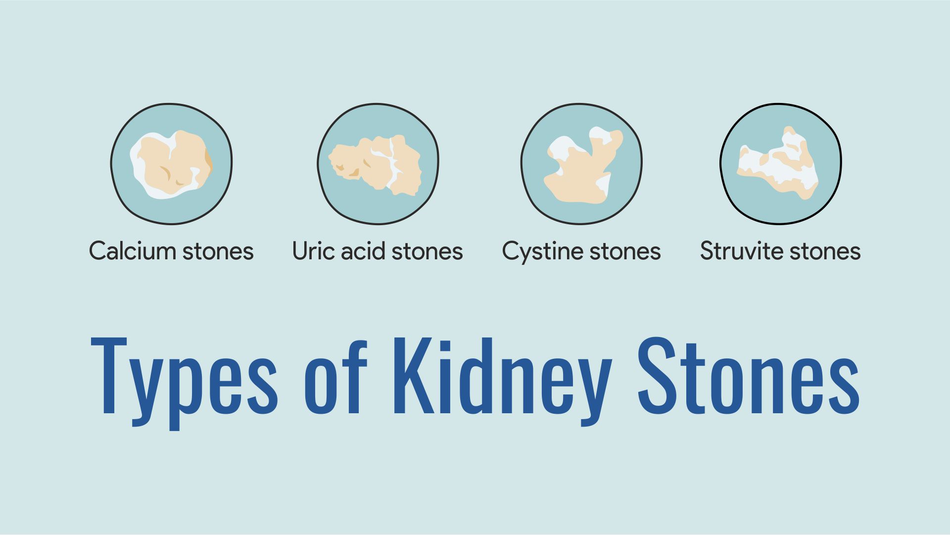 Types of Kidney Stones