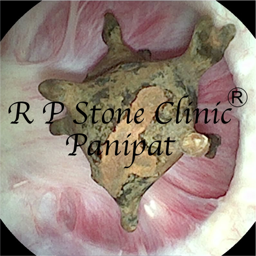 Kidney Stone Image 1