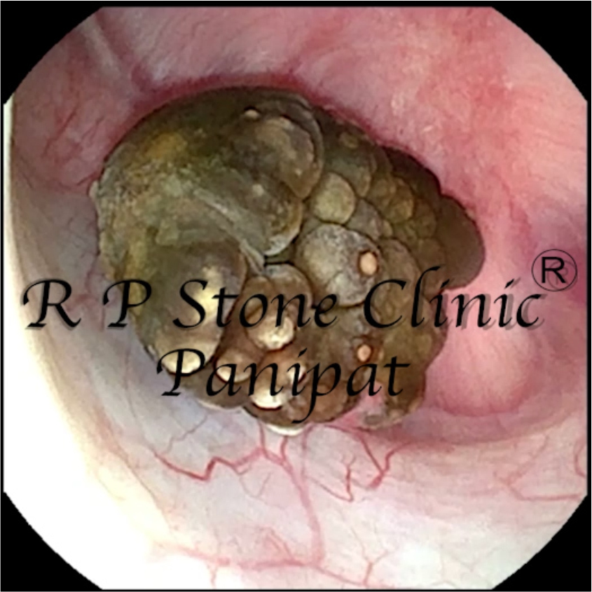 Kidney Stone Image 2