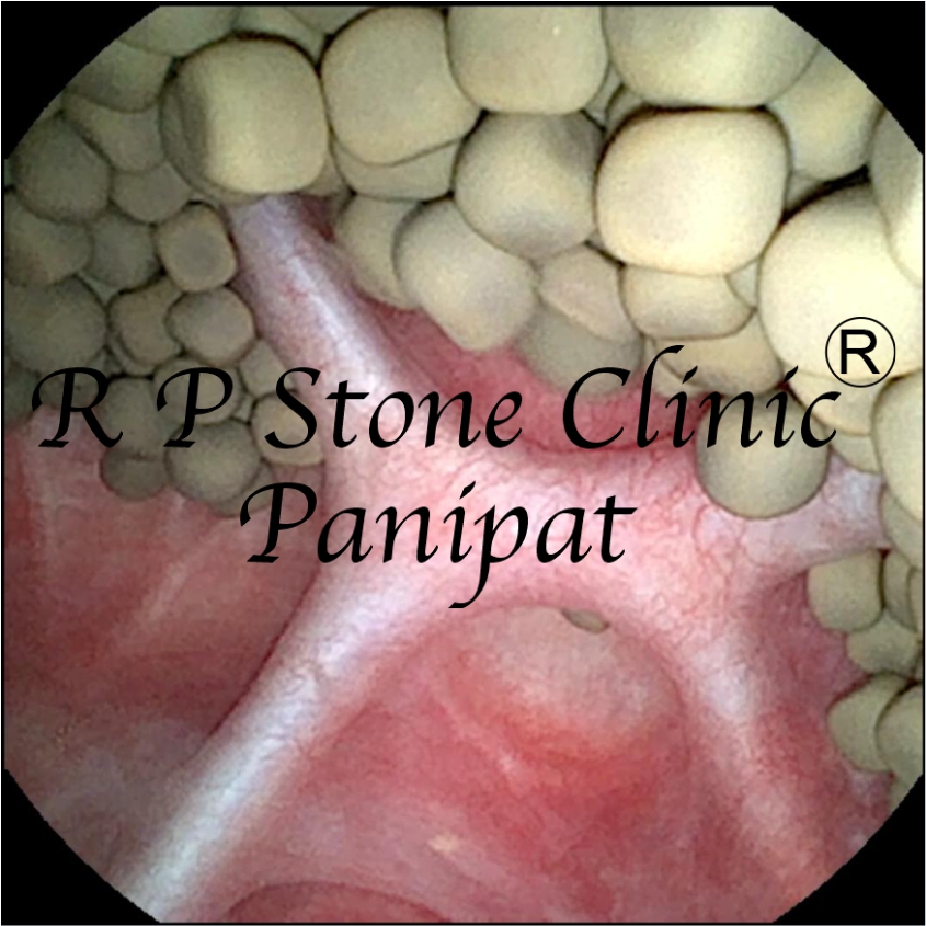 Kidney Stone Image 3
