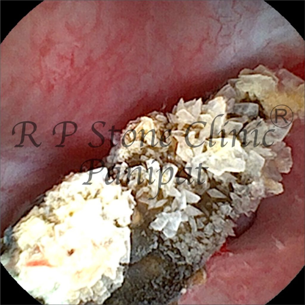 Vipul kidney stone image 1