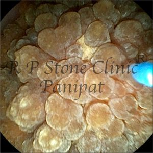 Israna kidney stone image 1