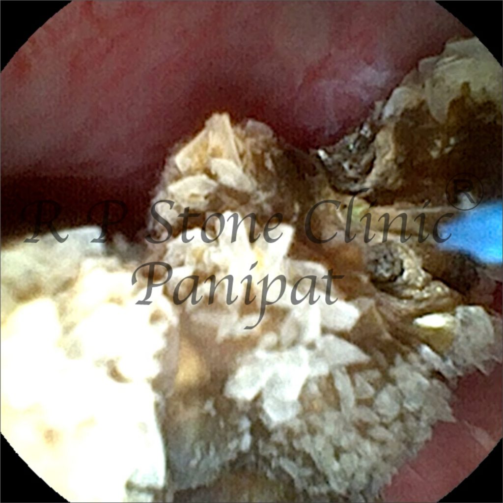 Vipul kidney stone image 2