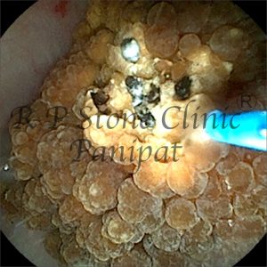 Israna kidney stone image 2