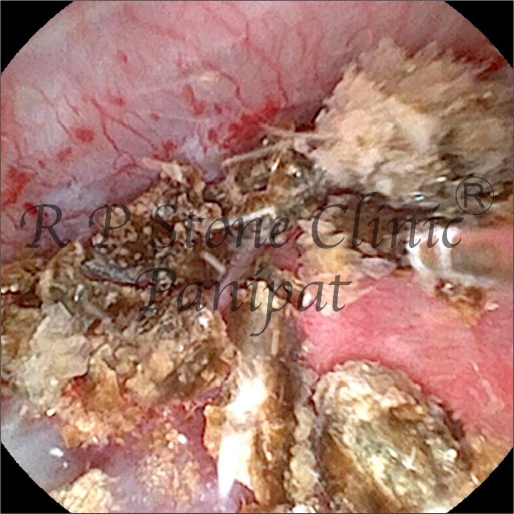 Vipul kidney stone image 3