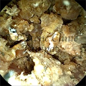 Israna kidney stone image 3
