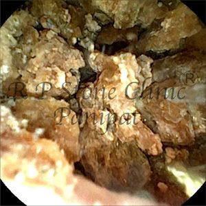 Israna kidney stone image 4