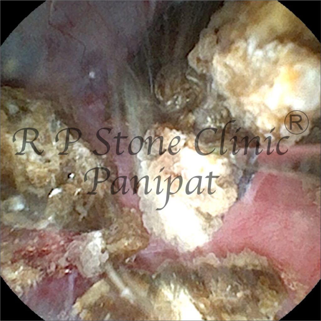 Vipul kidney stone image 5