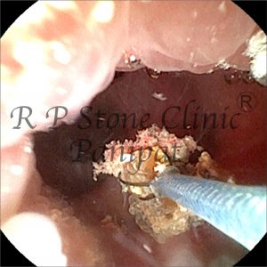 Israna kidney stone image 5