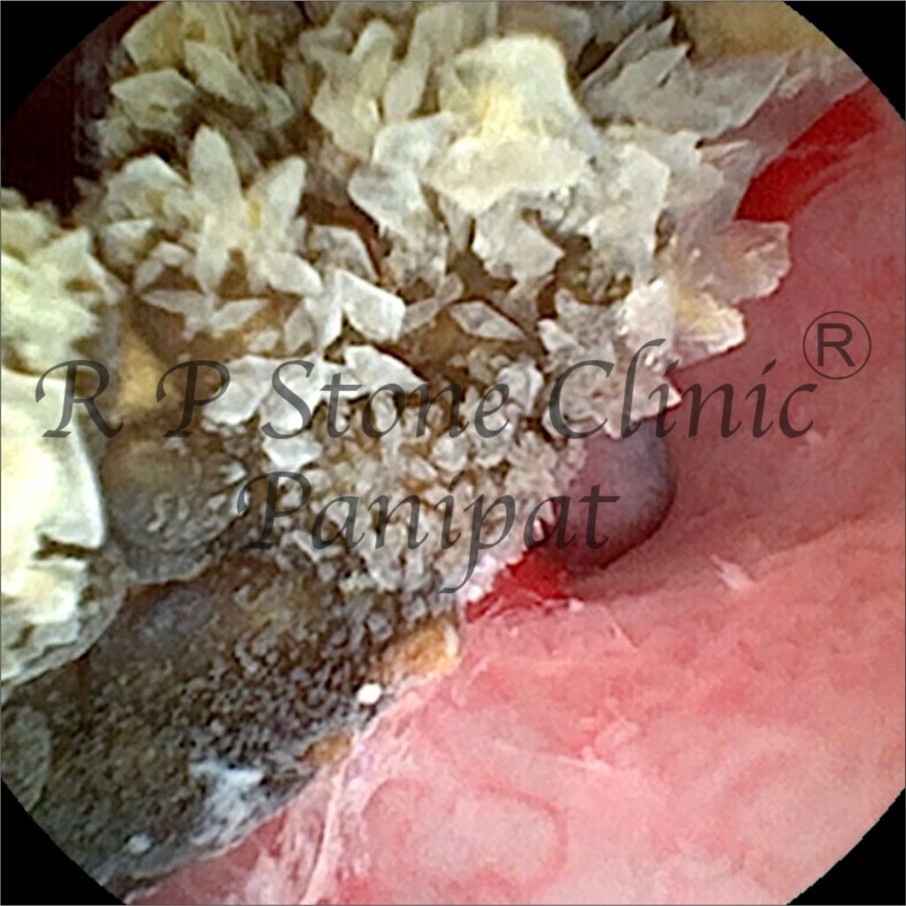 Vipul kidney stone image 6