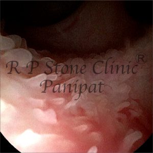 Israna kidney stone image 6