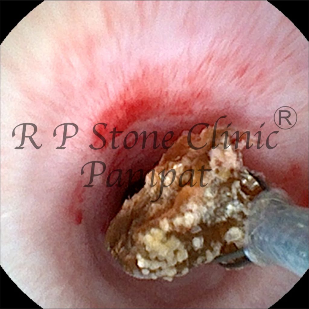 Vipul kidney stone image 7