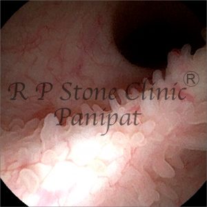 Israna kidney stone image 7
