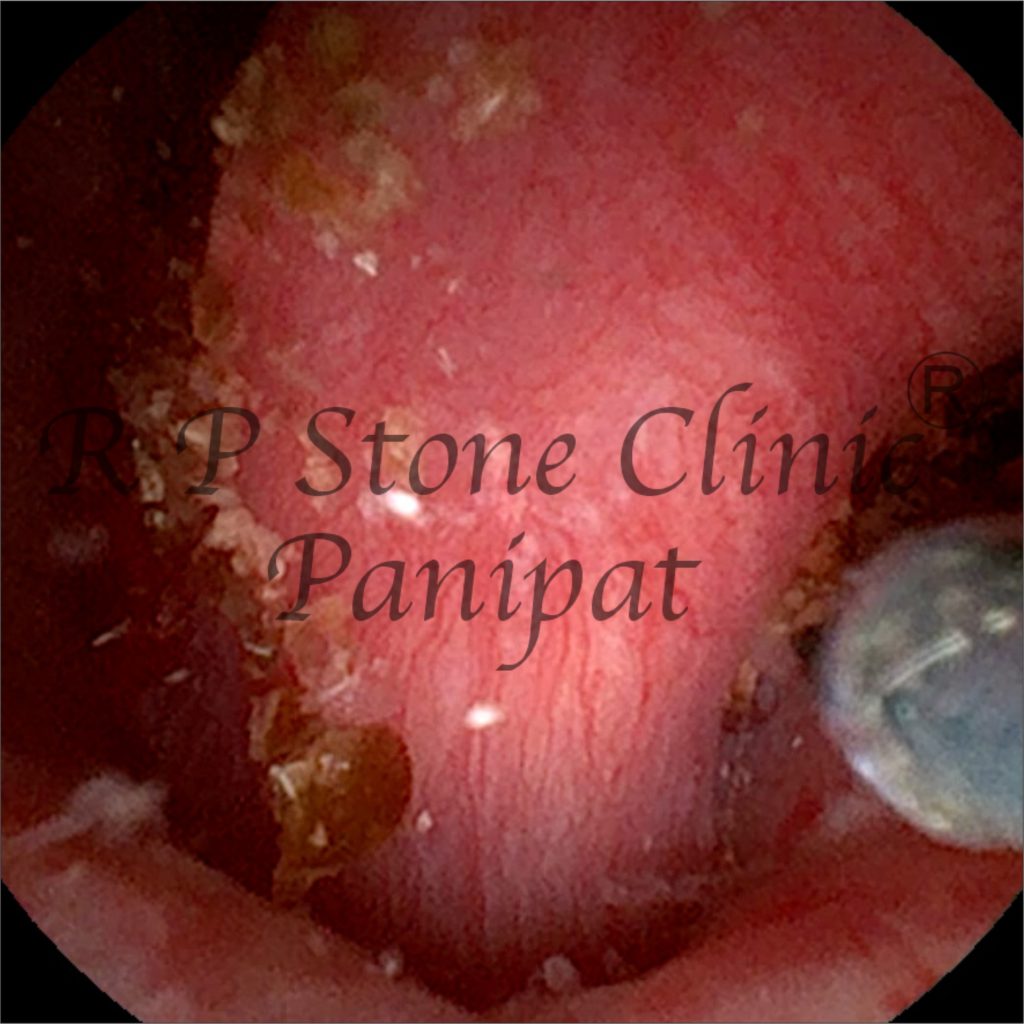 Vipul kidney stone image 8