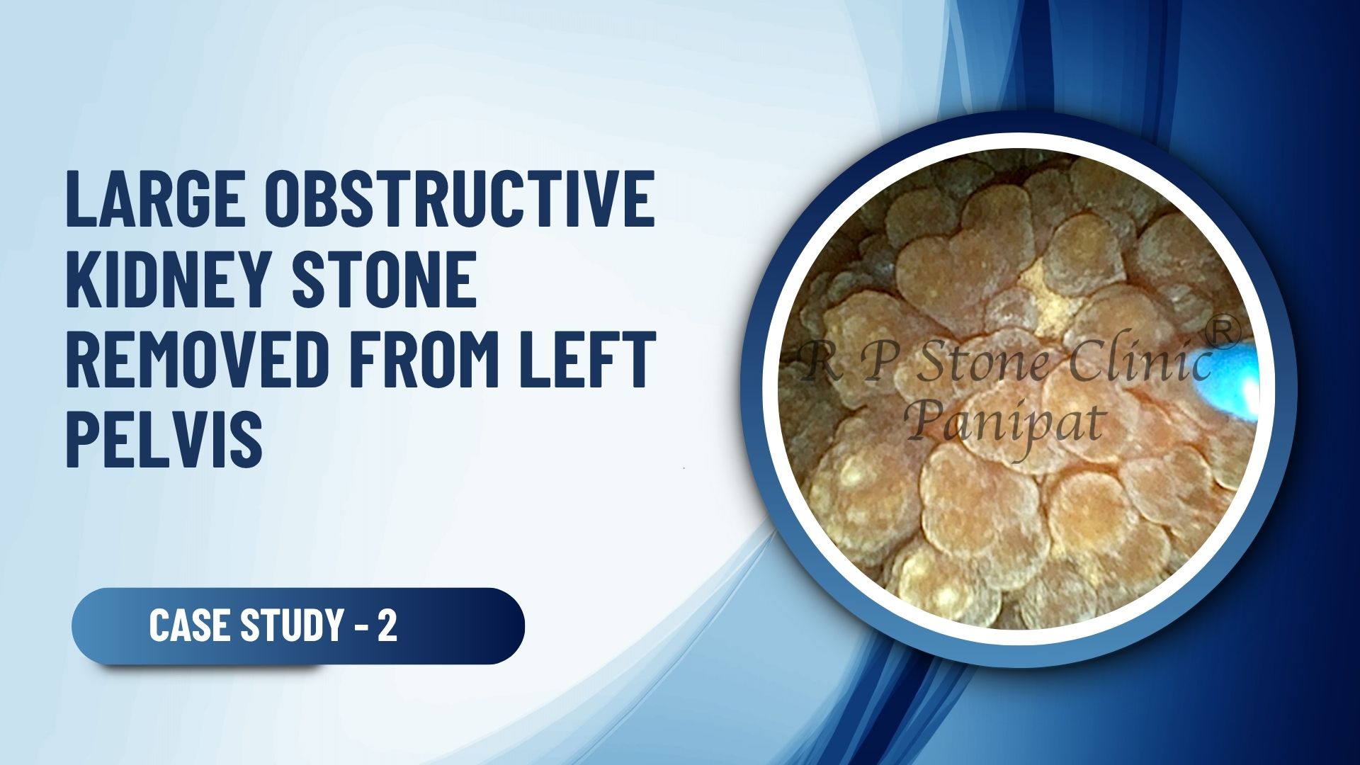 Large Obstructive Kidney Stone Removed