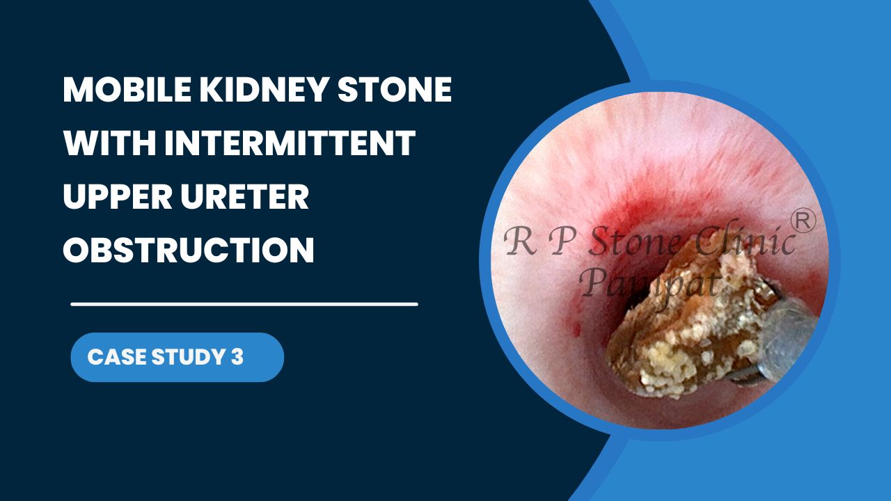 Mobile Kidney Stone with Intermittent Upper Ureter Obstruction