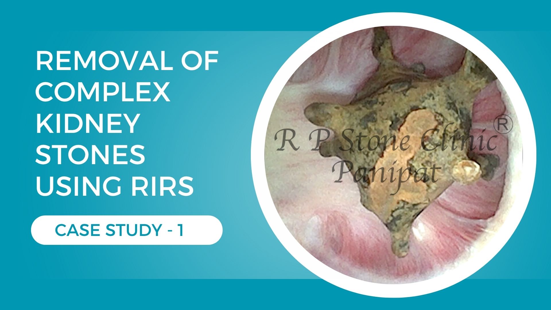 Removal of Complex Kidney Stones