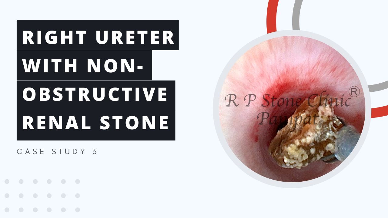 Right Ureter with Non-Obstructive Renal Stone