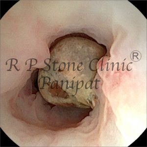 anil kidney stone image 1