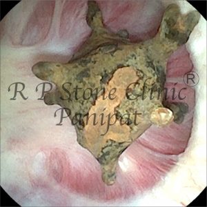 anil kidney stone image 2