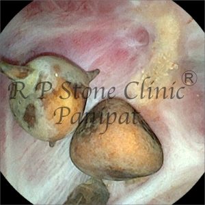 anil kidney stone image 3
