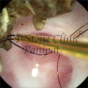 anil kidney stone image 4