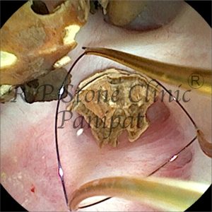 anil kidney stone image 5