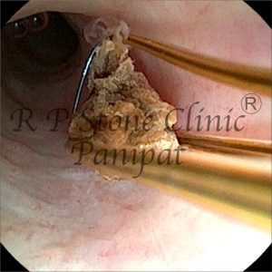anil kidney stone image 6