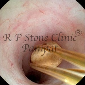 anil kidney stone image 7