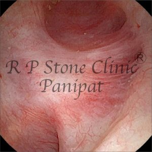 anil kidney stone image 8